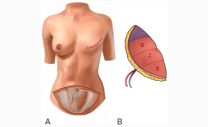 Breast reconstruction surgery in Delhi - Dr Rajat Gupta