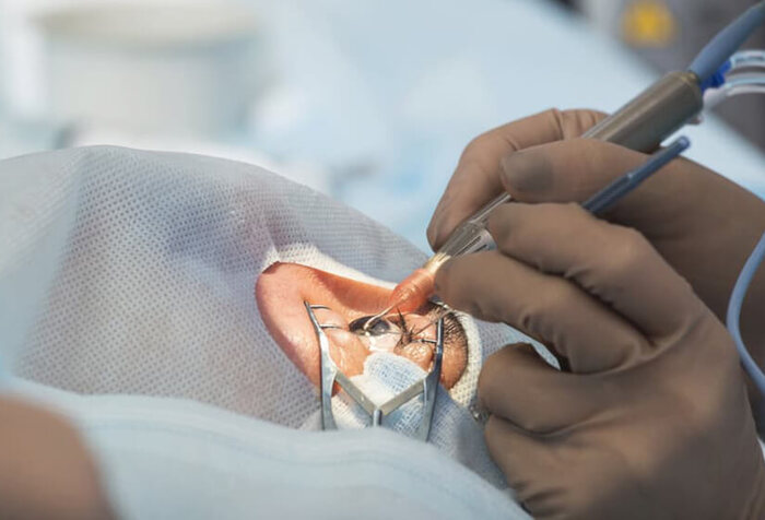 Can I Live With Cataracts Without Surgery?