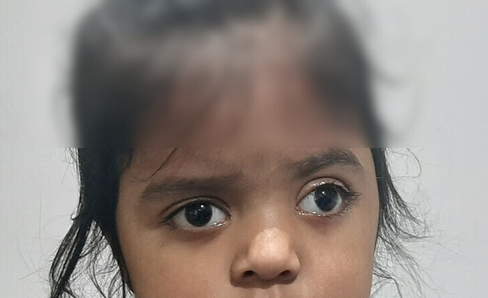 Squint Eye Surgery in Delhi | Squint Surgery Cost - Dr Anisha Gupta