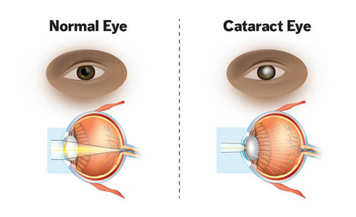 Cataract Eye Surgery in Delhi | Cataract Surgery Cost - Dr Anisha Gupta