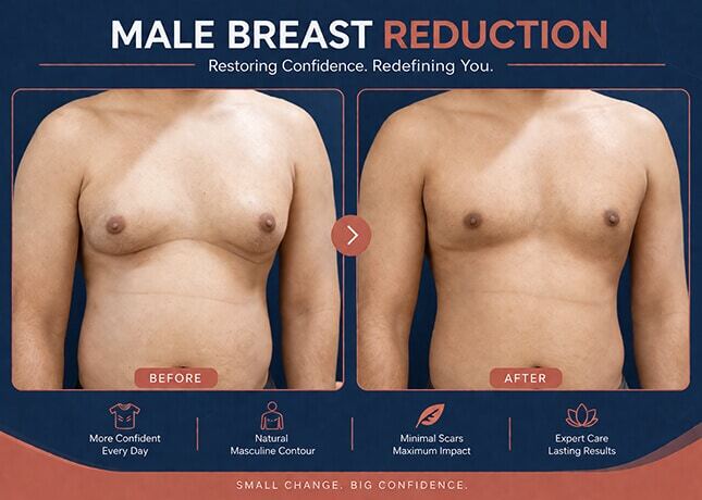 Gynecomastia Surgery &amp; Cost In Delhi | Male Breast Reduction - Dr Rajat Gupta
